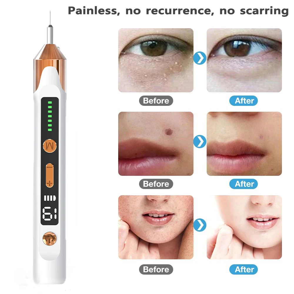 Plasma Pen Mole Removal Wart Spots Dark Dpot Black Dot Nevus Freckle Flat Blemish Pimples Removal for Face Body Skin Tag Remover