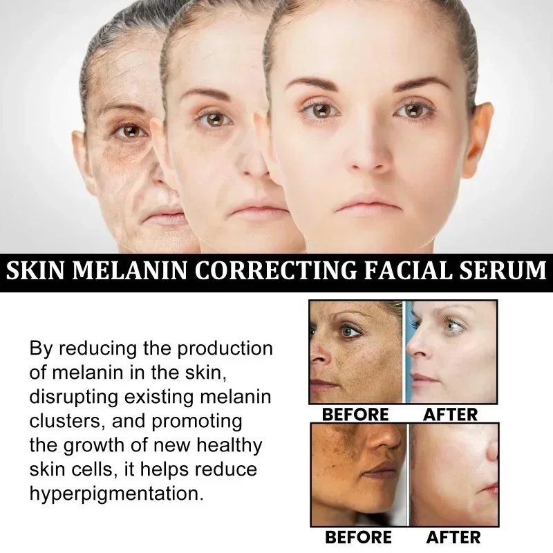 Heallor Отбеливающая сыворотка для веснушек Fade Melasma Темные пятна Удаление пигмента Осветление Осветление меланина Улучшение тусклого антивозрастного лица Лыжи