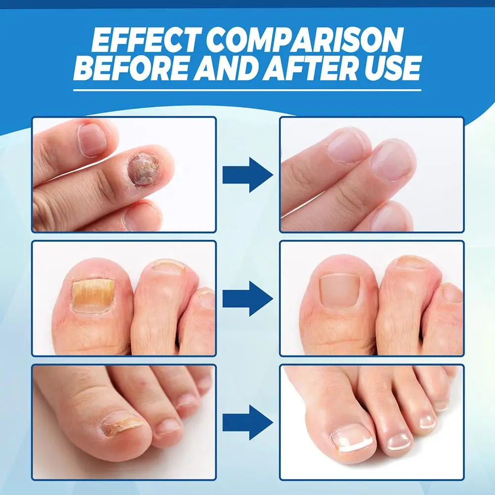 Dispositivo per il trattamento laser dei funghi delle unghie Riparazione dell'unghia del piede Trattamento dei funghi delle unghie Onicomicosi Unghie laser con rilassamento dei funghi