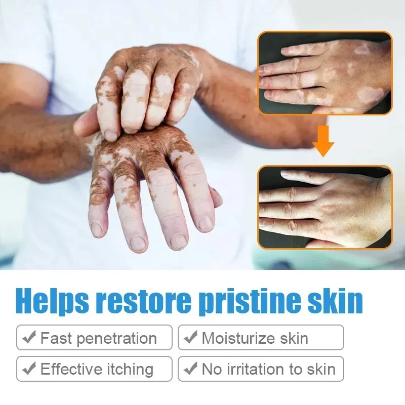 Pomada de extracto de hierbas de Vitiligo, crema de tratamiento para eliminar manchas blancas de la piel, elimina el Vitiligo