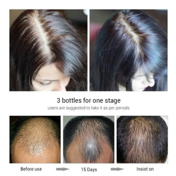 300/400/500ML Optional Hair Care Hair Growth Essential Oil Loss Liquid Care Beauty Growth Spray for Men Women