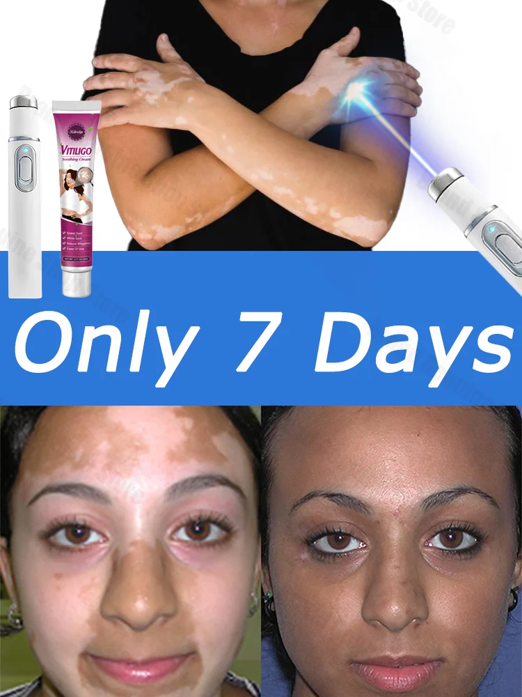 

Quickly Improve Vitiligo Laser