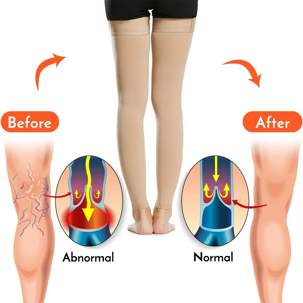 Meias de alta compressão para varizes, dedo do pé aberto, suporte firme, 30 mmHg, homens e mulheres, 1 par