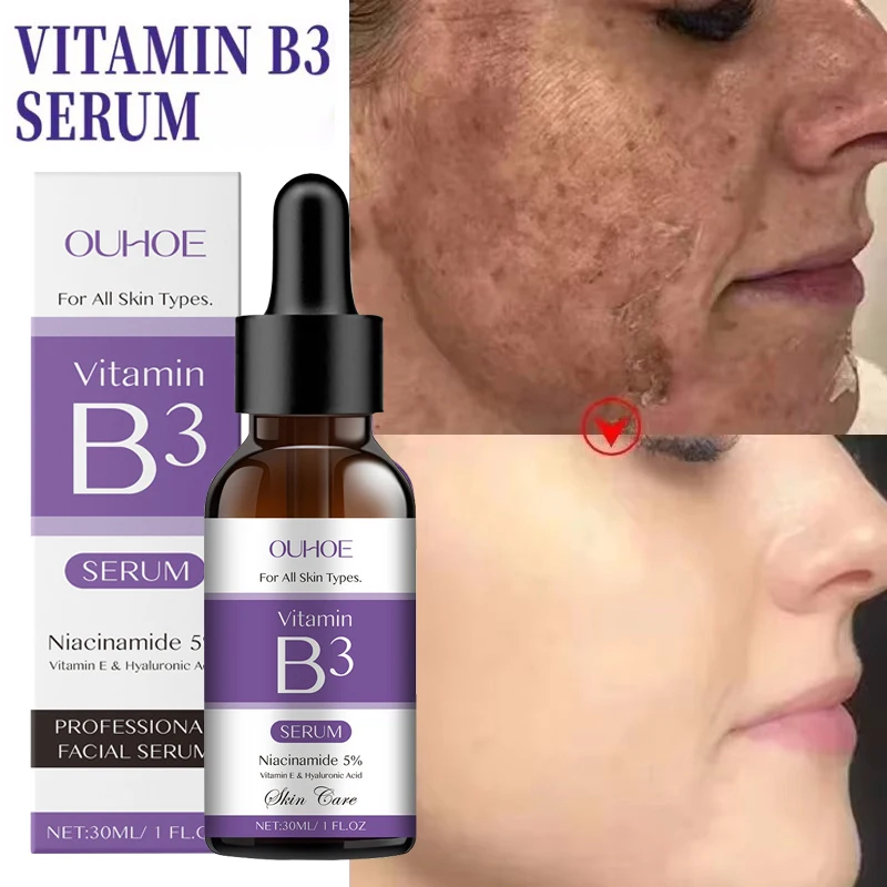 Hoygi-suero Facial de niacinamida, vitamina B3, pigmento para arrugas, eliminación de manchas oscuras, suero corrector brillante, crema hidratante blanqueadora Facial