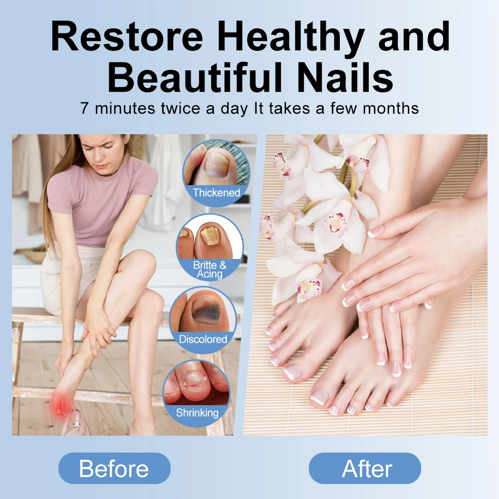 เชื้อราเล็บ Cleaninglaser โคมไฟชาร์จเล็บพยาบาลสุขภาพอุปกรณ์สําหรับเล็บหนา Britte เปลี่ยนสีหดตัว