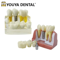 4 Times Implant Teeth Model Denture Bridge Crown Porcelain Restoration Model For Dentist Student Teaching Demonstration Module