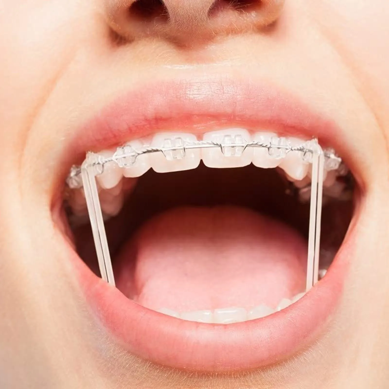 100 Stuks Elastiekjes Voor Tanden Verzorging Tanden Elastiek Beugel Tanden Corrigeert Misvorming 3.5 Oz 3/8