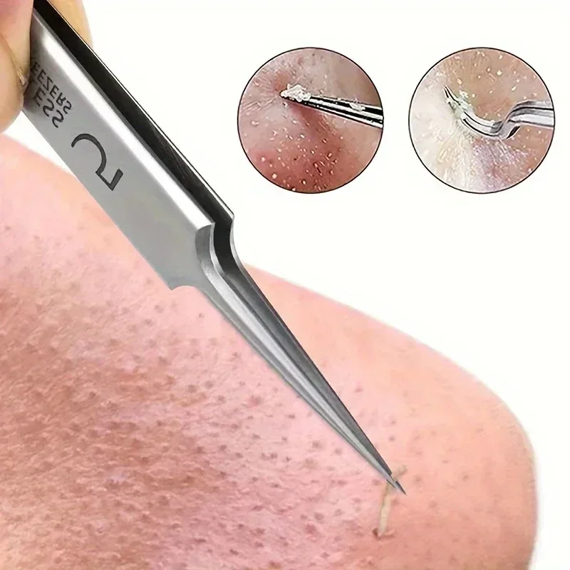 1 Unidade de Caneta Extra Fina No. Kit de 5 Pinças para Acne e Cravos - Ferramentas de Beleza Facial para Remoção de Acne e Cuidados com a Pele