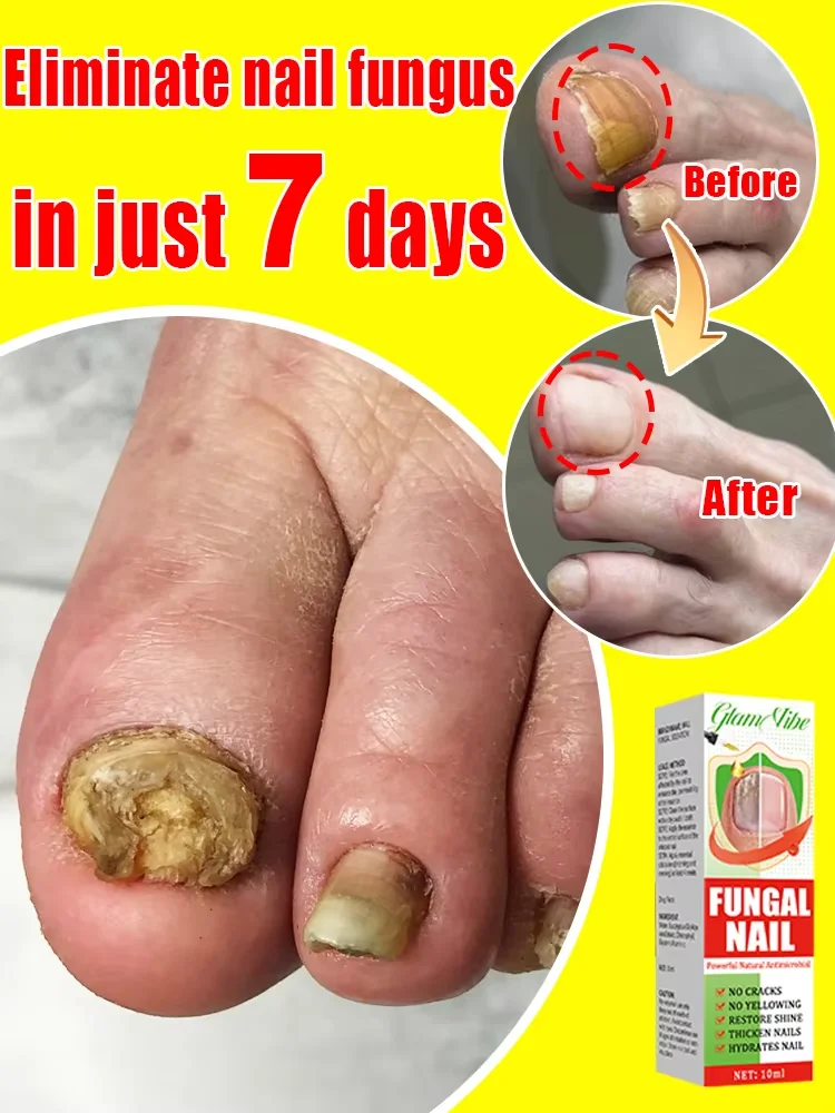 

Onychomycosis Killer Essence Strong Edition: One-click removal, never relapse
