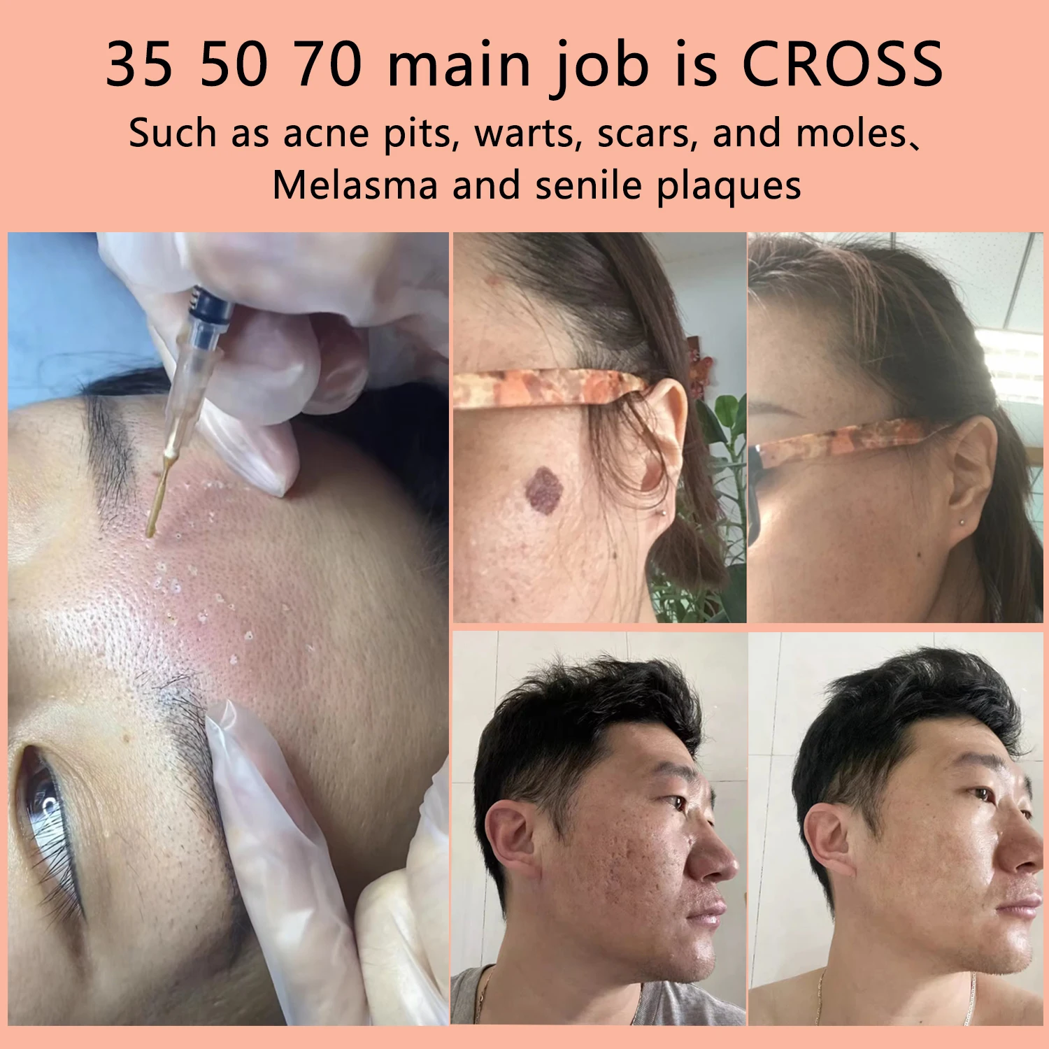 TCA chemical peel 30ml vial 100% Pure Cleaning tools peel cross 20 30 35 50 70 High concentration cleaning peeling burn Burning - view 5
