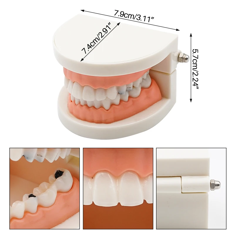 1pc Dental Model Dental Caries Model Teeth Periodontal Disease Model Dentist Material Dental Teaching Models Study