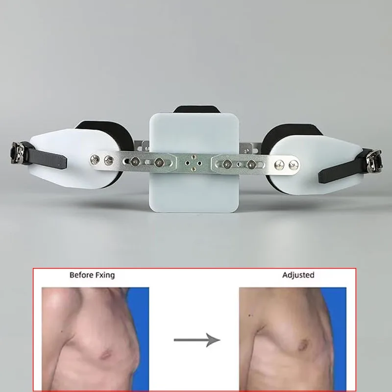 Adjustable Pectus Carinatum Orthosis Brace Pigeon Chest Orthosis Support Ribs Valgus Orthosis Braces Kids Adults Universal