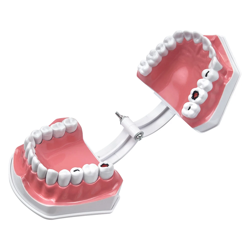 Dental Caries Model Plastic Teeth Model With Toothbrush Removable Dental Model Teeth Brushing Model For Studying Teaching Demo