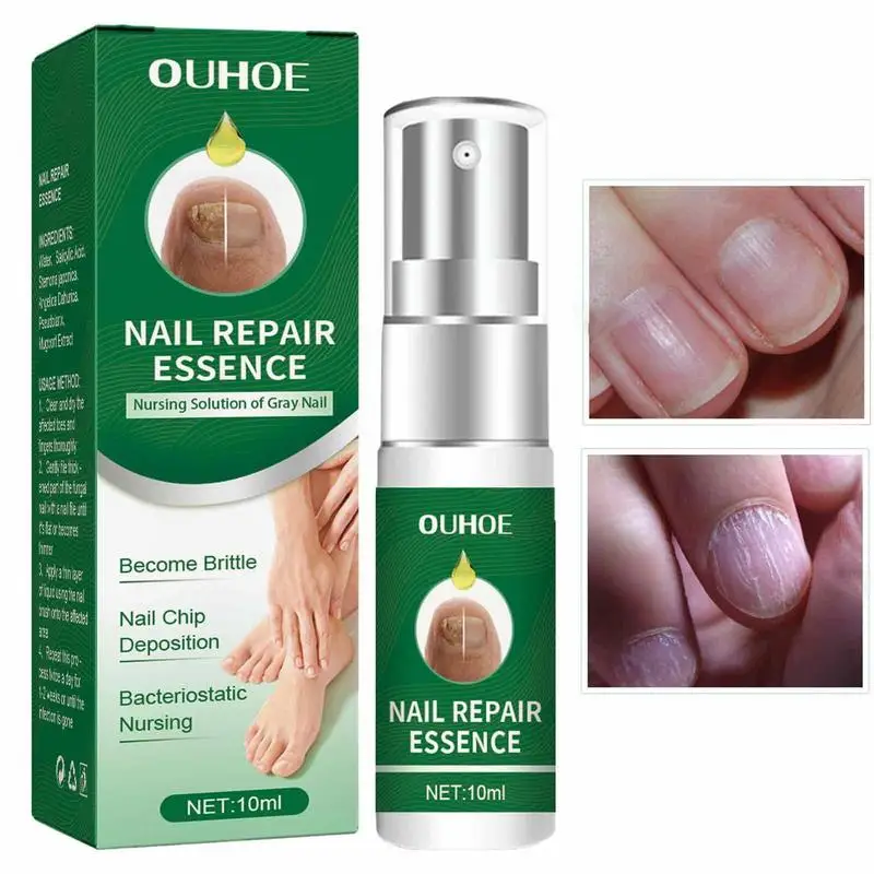 Essência do reparo do prego para o cuidado do toenail, solução para reparar o molde danificado, quebrado rachado, soro descolorido das unhas, essência natural, correção