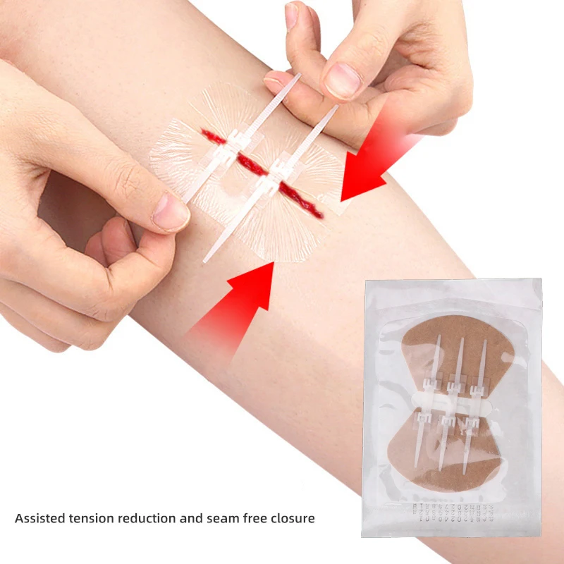Suture-free Wound Closure Device Zipper Band-aid Painless Zip Suture Reducer Dressing Patches Band Aid for Outdoor Emergency Use