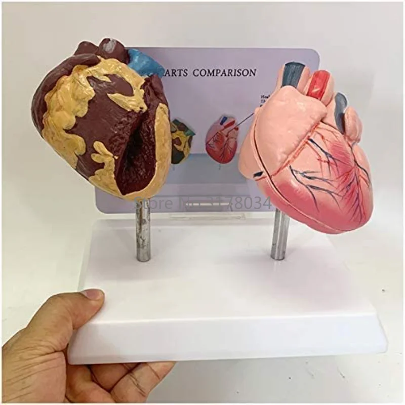 Human Heart Model Pathological Anatomical Heart Model Health and Smoking People Heart Comparison Model