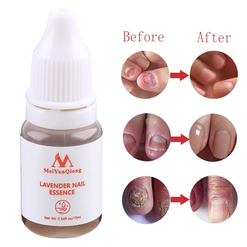 E1YE Repair Essence เซรั่มเชื้อราเล็บ Onychomycosis กำจัดเล็บ