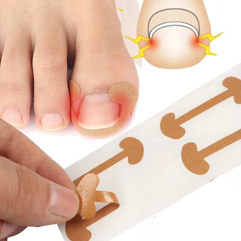 Ingrown Toenail Correction Strips Lasting Adhesion Waterproof Nail Correction Stickers Elasticity Toe Care Pedicure Tools