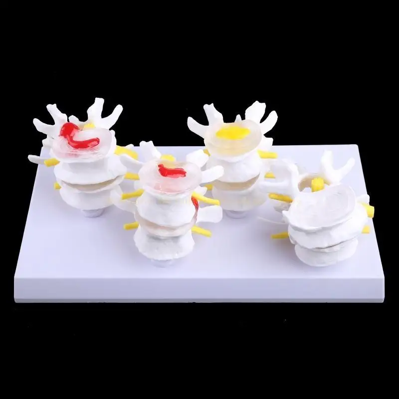 1 Set Human Lumbar Lesion Spine Statue Display Model Medical Teaching Learning f