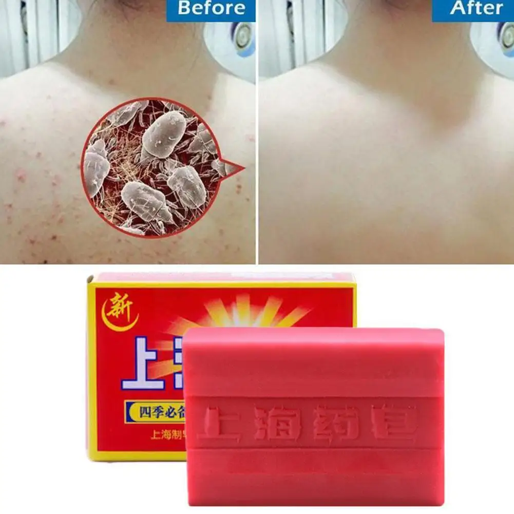 90g Red China Medicated Soap Conditions Acne Psoriasis Bath Cream Soap Fungus Body Anti Eczema Slimming Seborrheic Healthy