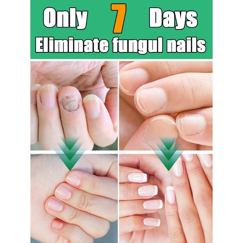 

Toenail Nail Fungus Treatment Repair Fingernail Device Toenail Treatment for Foot Nail Fungus Essential Oil Onychomycosis Care