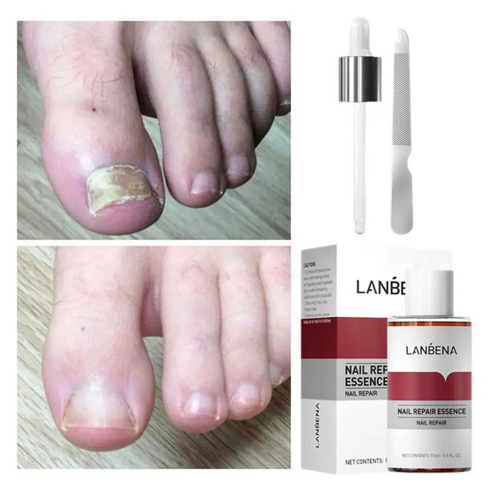 15ml LANBENA Fungal Nail Treatment Feet Care Essence Fungus Infection Paronychia Healthy Serum Repair Removal Onychomycosis T4N4