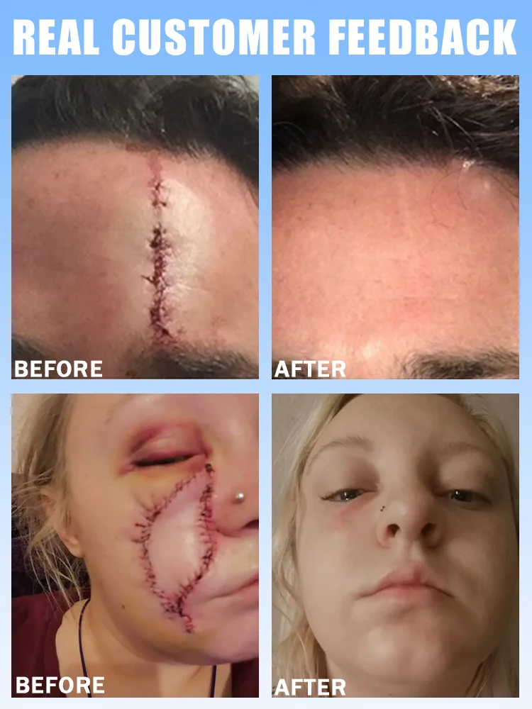 ᴾʳᵒᶠᵉˢˢⁱᵒⁿᵃˡ ˢᶜᵃʳ ʳᵉᵐᵒᵛᵃˡ ⁻ ⁿᵉʷ ᵗᵉᶜʰⁿᵒˡᵒᵍʸ ˡᵃˢᵉʳ ᵖᵉⁿ⸴ ˡⁱᵍʰᵗᵉⁿ ˢᶜᵃʳˢ ʷⁱᵗʰⁱⁿ ⁷ ᵈᵃʸˢ⸴ ʳᵉᵍᵃⁱⁿ ᶜᵒⁿᶠⁱᵈᵉⁿᶜᵉ ᵃⁿᵈ ᶜʳᵉᵃᵗᵉ ᵖᵉʳᶠᵉᶜᵗ ˢᵏⁱⁿ