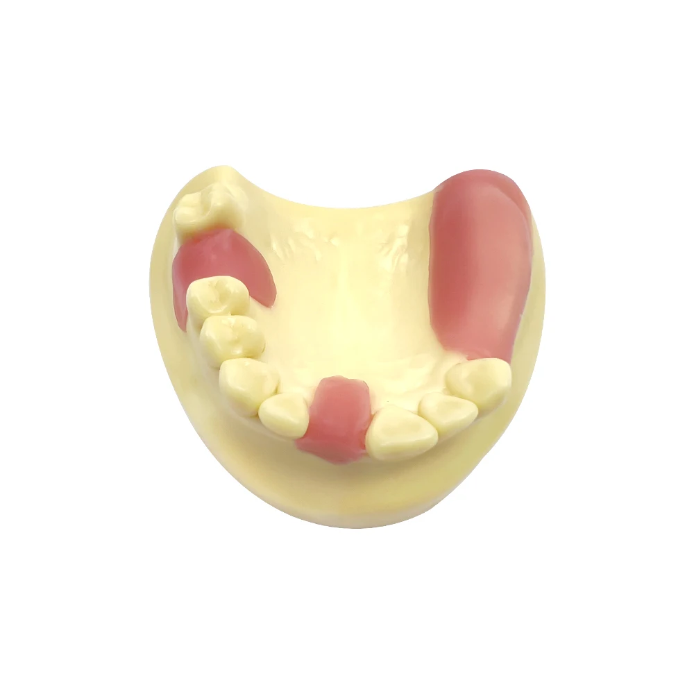 치과 Typodont 임플란트 연습 모델, 하악골 오버 틀니, 부드러운 잇몸 수리 데모, 클리닉 훈련 교육용