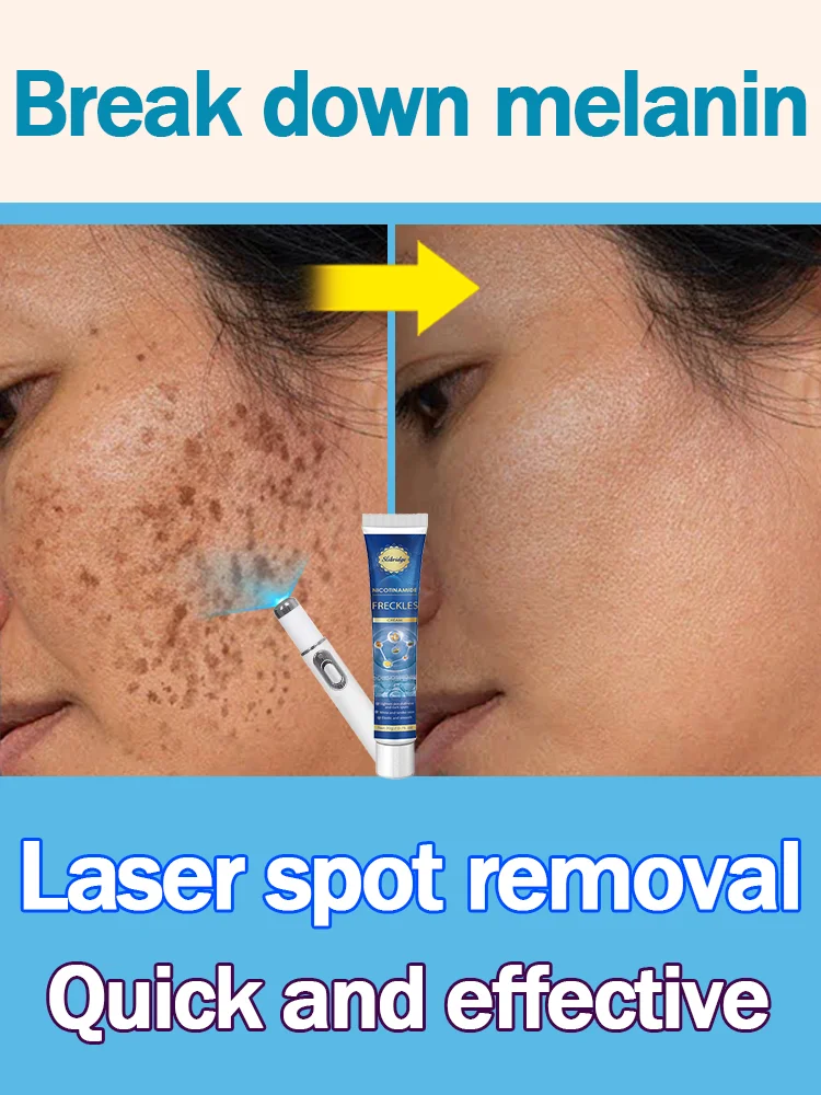 

Laser can quickly eliminate facial spots