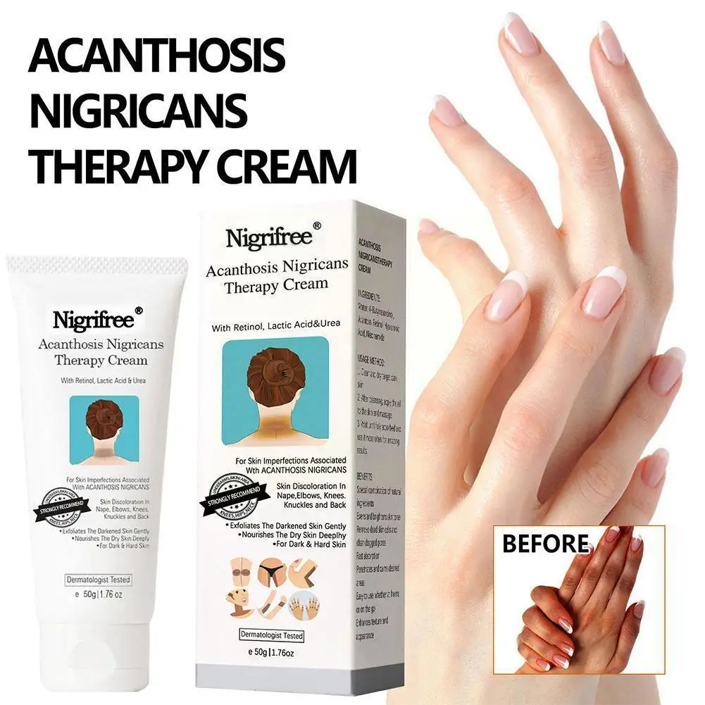 Acantosis Nigricans crema de terapia blanqueadora corporal eliminación de hiperpigmentación para el cuidado de las partes oscuras del cuerpo como el cuello, An D2e2