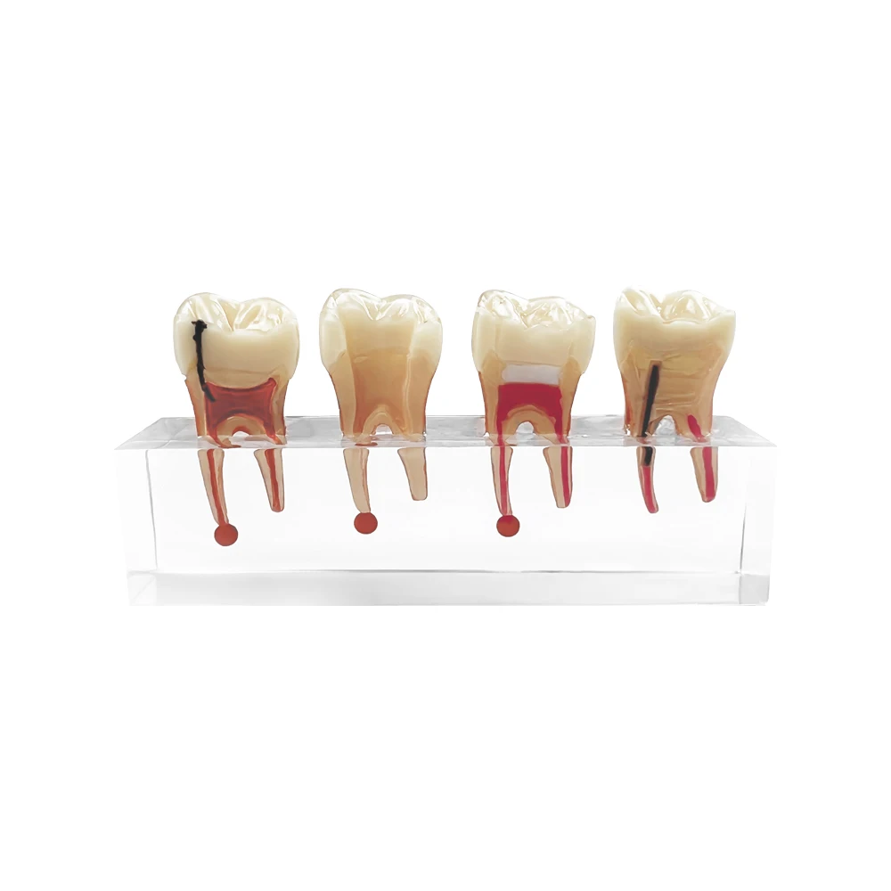 

Transparent Pathological Teeth Model For Studyting Teaching Education Patient Communication Demonstration Dental Model Pathology