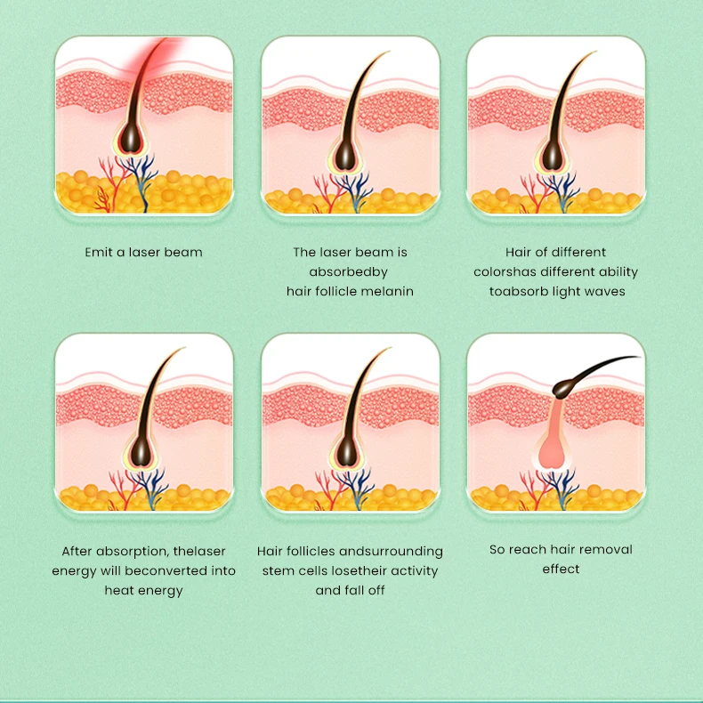 ماكينة إزالة الشعر بالليزر من البلاتين الجليدي القوية من الكسندريت سوبرانا، ماكينة ليزر ديود احترافية، مزيل شعر دائم للنساء #3