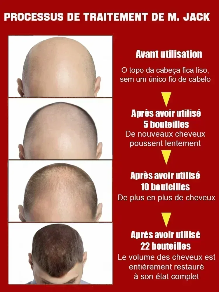 2025 biotina óleo de crescimento rápido do cabelo soro de recrescimento do cabelo tratamento de desbaste do cabelo líquido de crescimento do cabelo anti-perda de cabelo para mulheres e homens