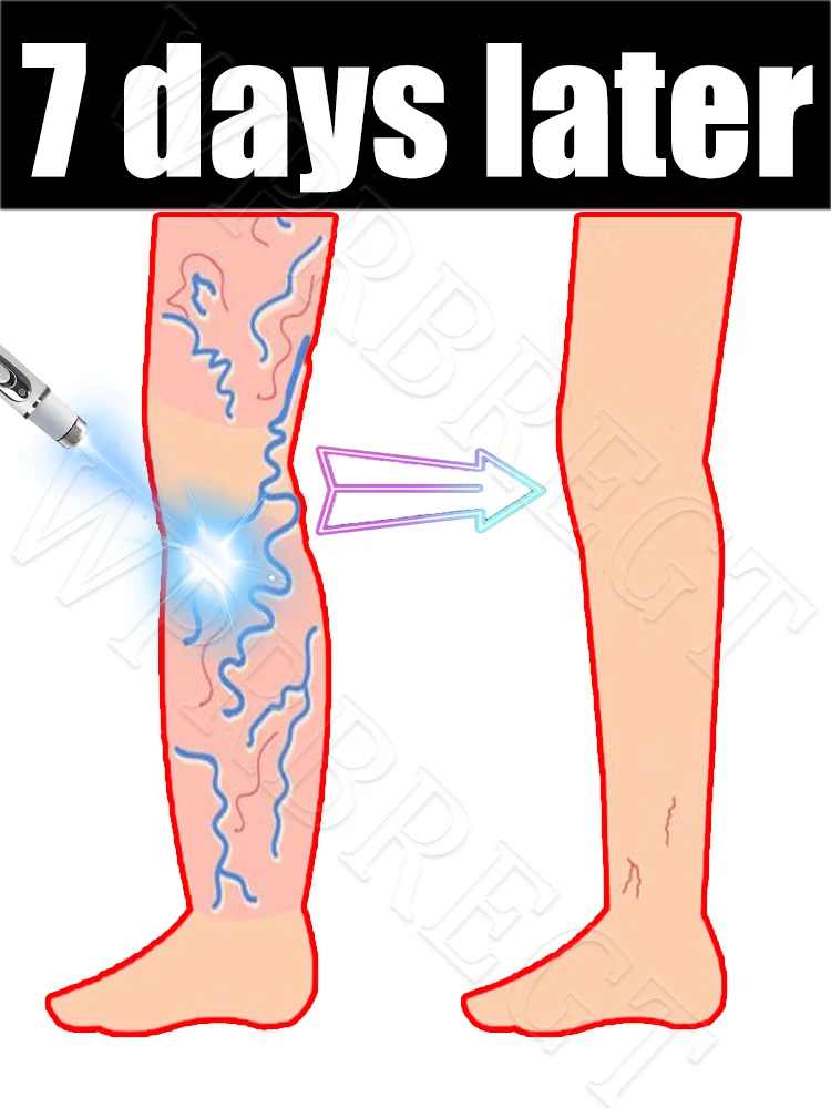 

Легко снимает боль в ногах-паука и одновременно улучшает васкулит и флебит с помощью лазерной указки терапевтического уровня.