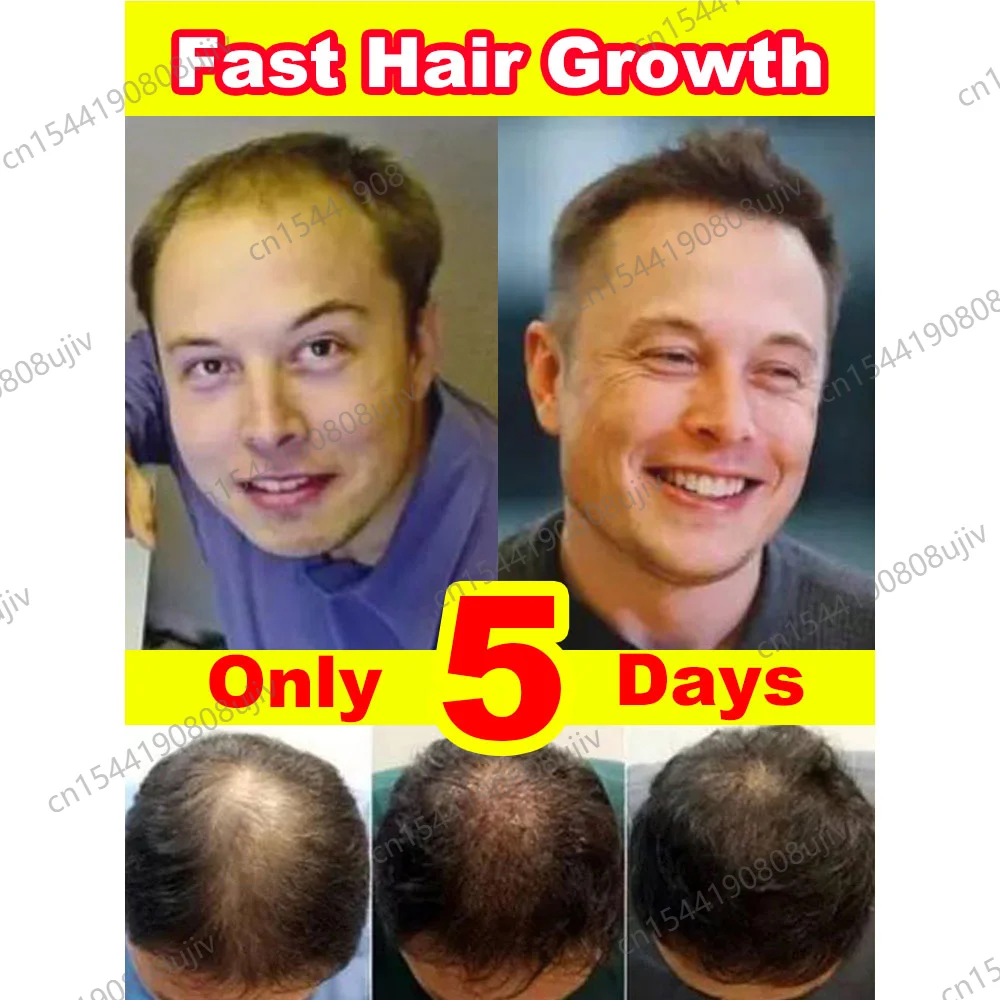 

30 ML Rosemary Oil For Hair Growth Solution Fast Effective Hair Growth Products For Men Women Anti-Hair Loss Baldness Repair