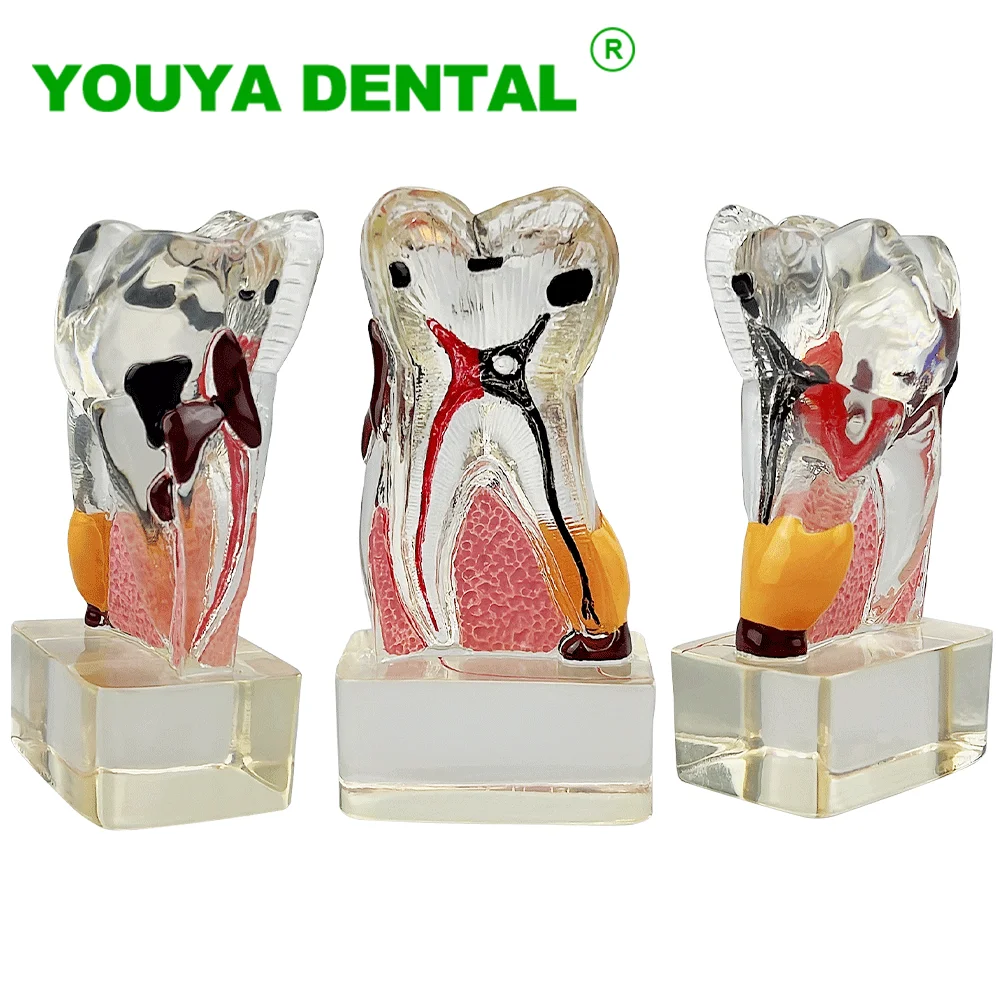 

Teeth Anatomy Dental Model Teaching Study Transparent Molar Periodontal Disease Model Dentistry Dentist Demonstration Model