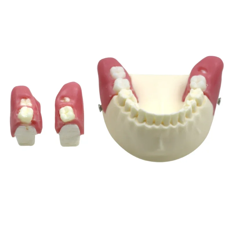 

GREATLH Dental Wisdom Tooth Extraction Model Impacted Tooth Extraction Model Soft Gum Dentisty Study Training Model Dental Tools