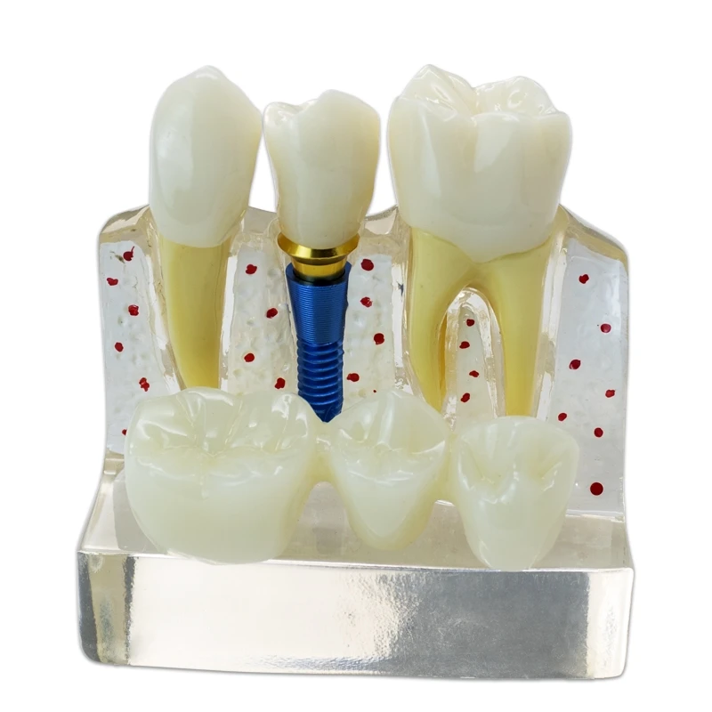 4 Times Dental Teach Implant Analysis Crown Bridge Removable Model Dental Demonstration Model Dentist Study Teaching Model