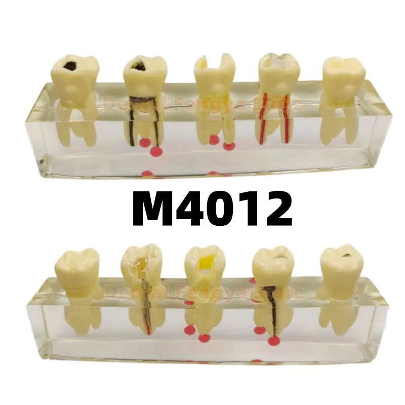 M4012 Dental Root Canal Pathological Development Demonstration Model Teeth Pathology Display Model Teaching / Training /Demo