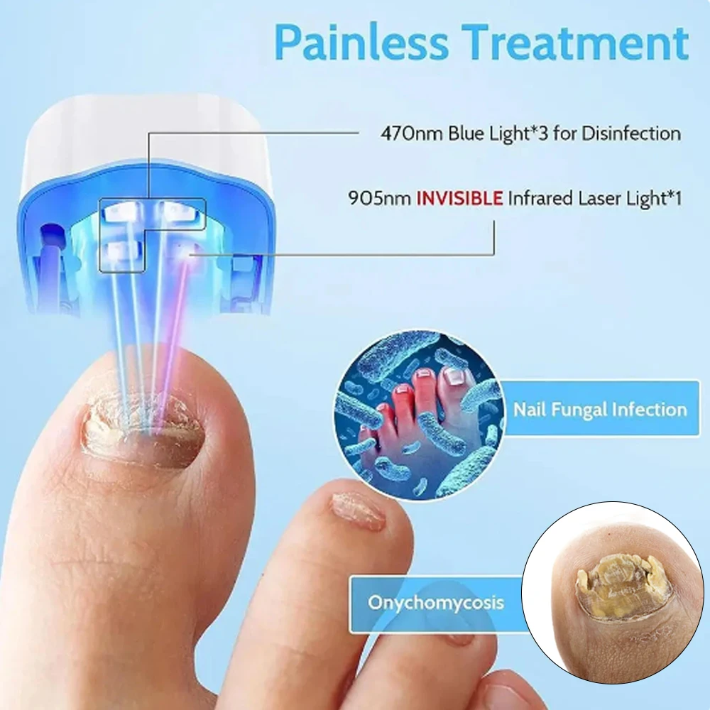 Fungal Nails Laser Treatment Device Nail Fungus Essence Repair Toenail Fingernail Fungus Treat Onychomycosis Removes Nail Fungus