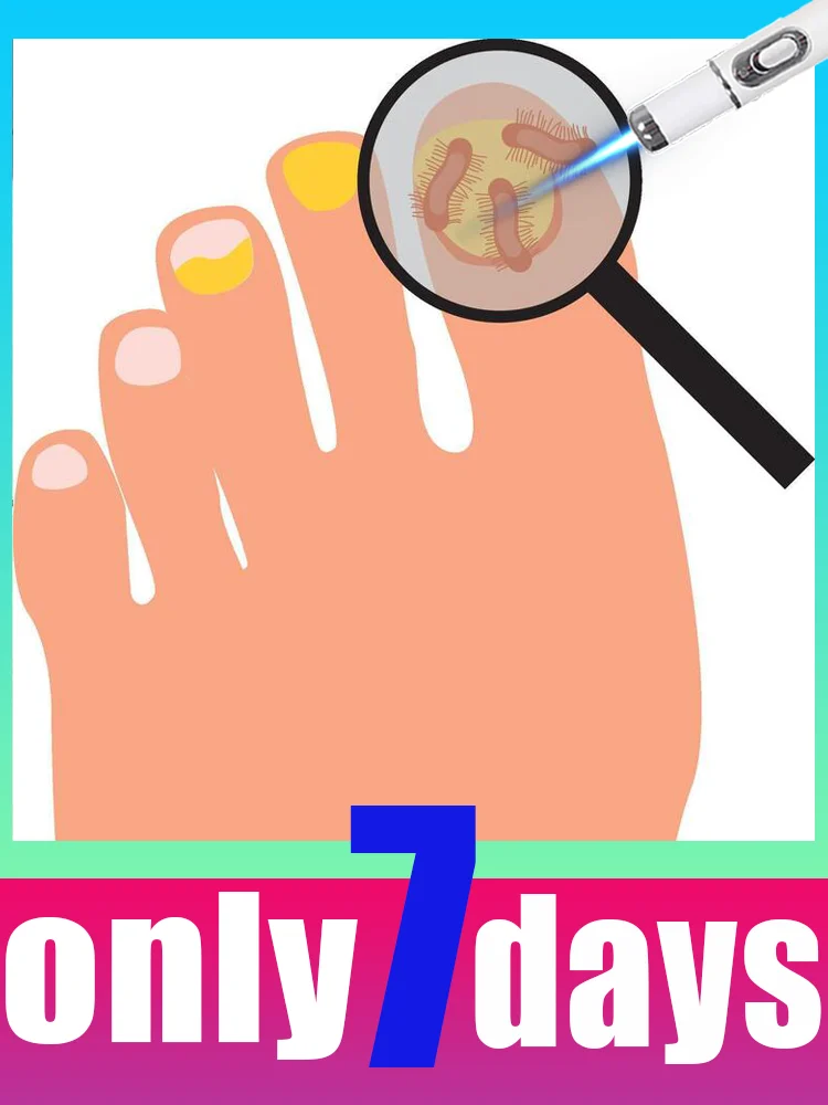 

2025 Anti-Fungal Technology Treat nail infection and nail loss Say Goodbye to Onychomycosis with blue Laser pen
