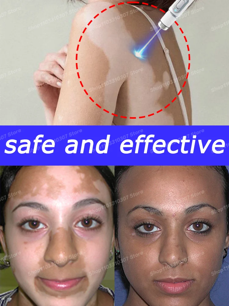 

Improve Skin Pigmentation and Reduce White Spots Vitiligo Treatment Cream