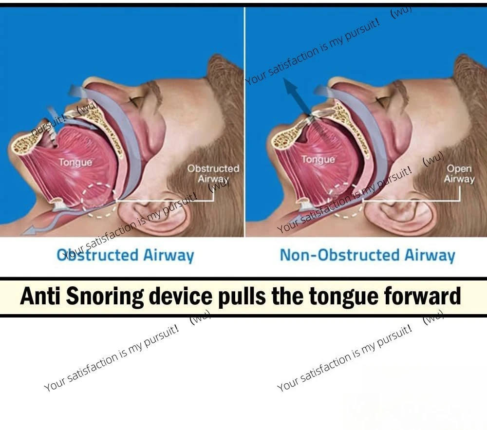 Anti-snoring mouth with tongue rest helps eliminate snoring, silicone
