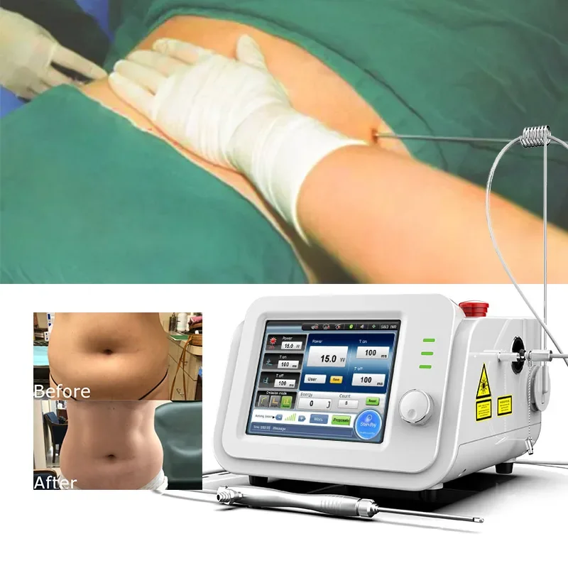 Aesthetic Anti Cellulite Weight Loss Endolift Plastic Surgery 980nm 1470nm Wavelength Laser Liposuction Device