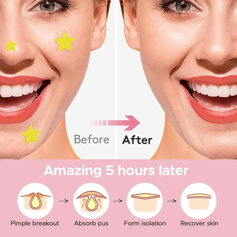 Star Acne Patch Blackheads And Closed Comedones Improve Acne Skin Hydrocolloid Acne Beauty Tools Star Pimple Patch