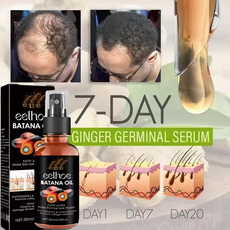 100% زيت باتانا النقي رذاذ نمو الشعر للرجال والنساء مكافحة فقدان الشعر إعادة نمو زيت طبيعي علاج فروة الرأس منتجات العناية بالشعر #6