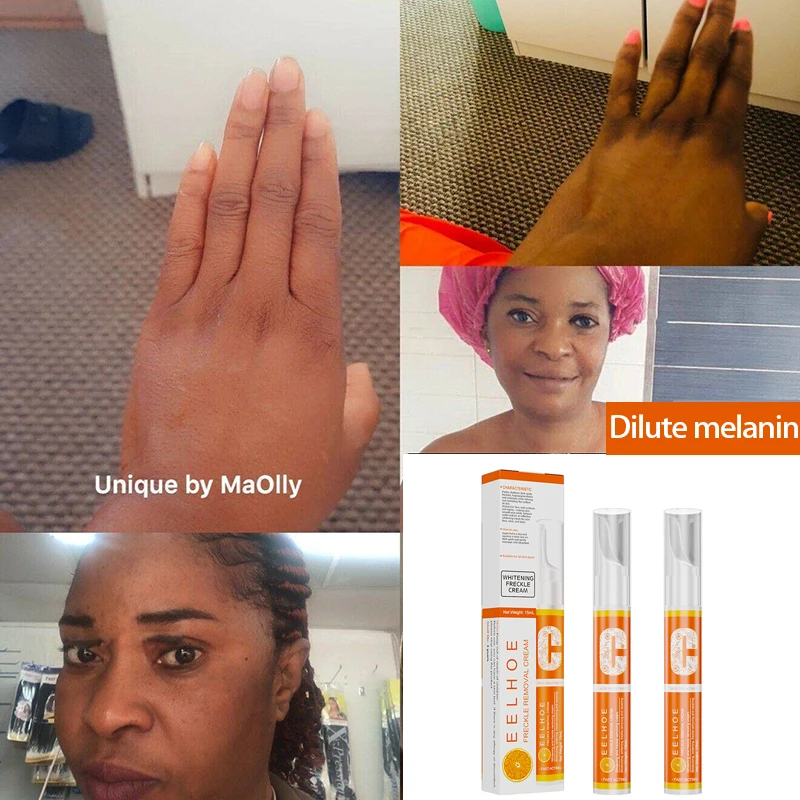 15ml verdünntes Melanin vc Aufhellung spunkt entfernen Creme entfernen Flecken aufhellen Hautton Bleaching Haut Gesichts pflege Peelings