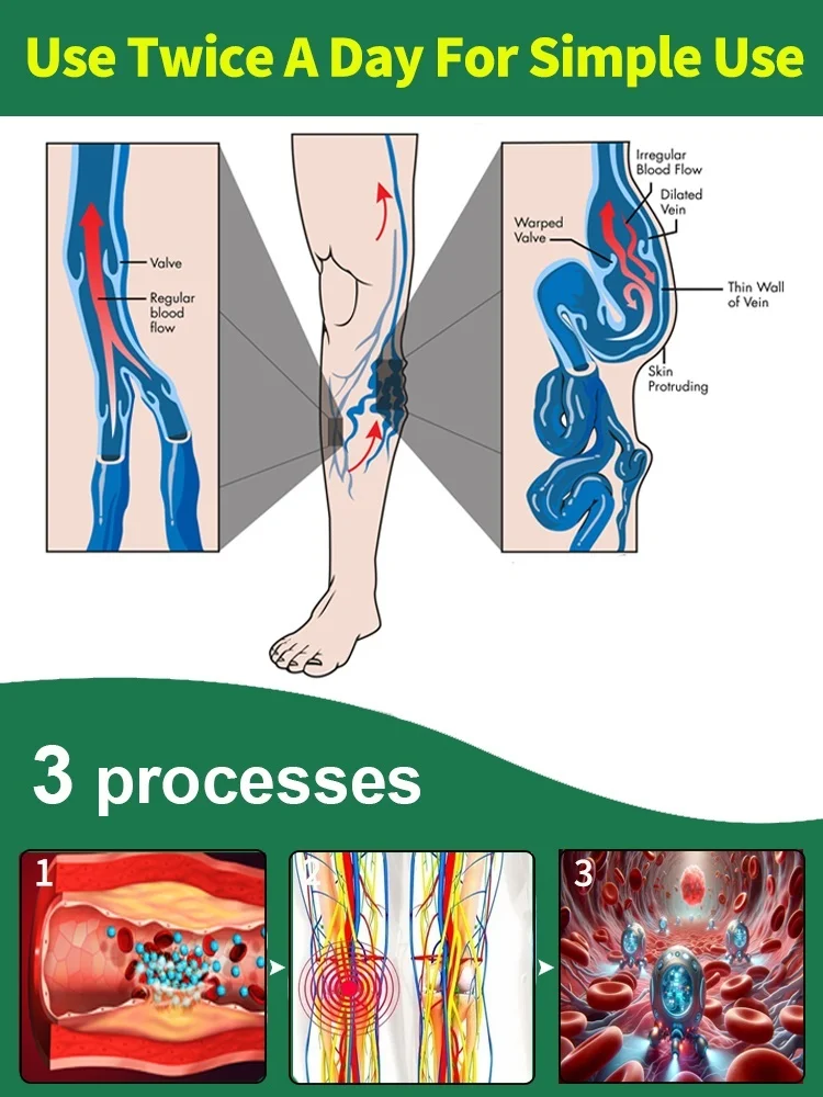 Say byebye to vasculitis, phlebitis, spider leg pain, varicose veins
