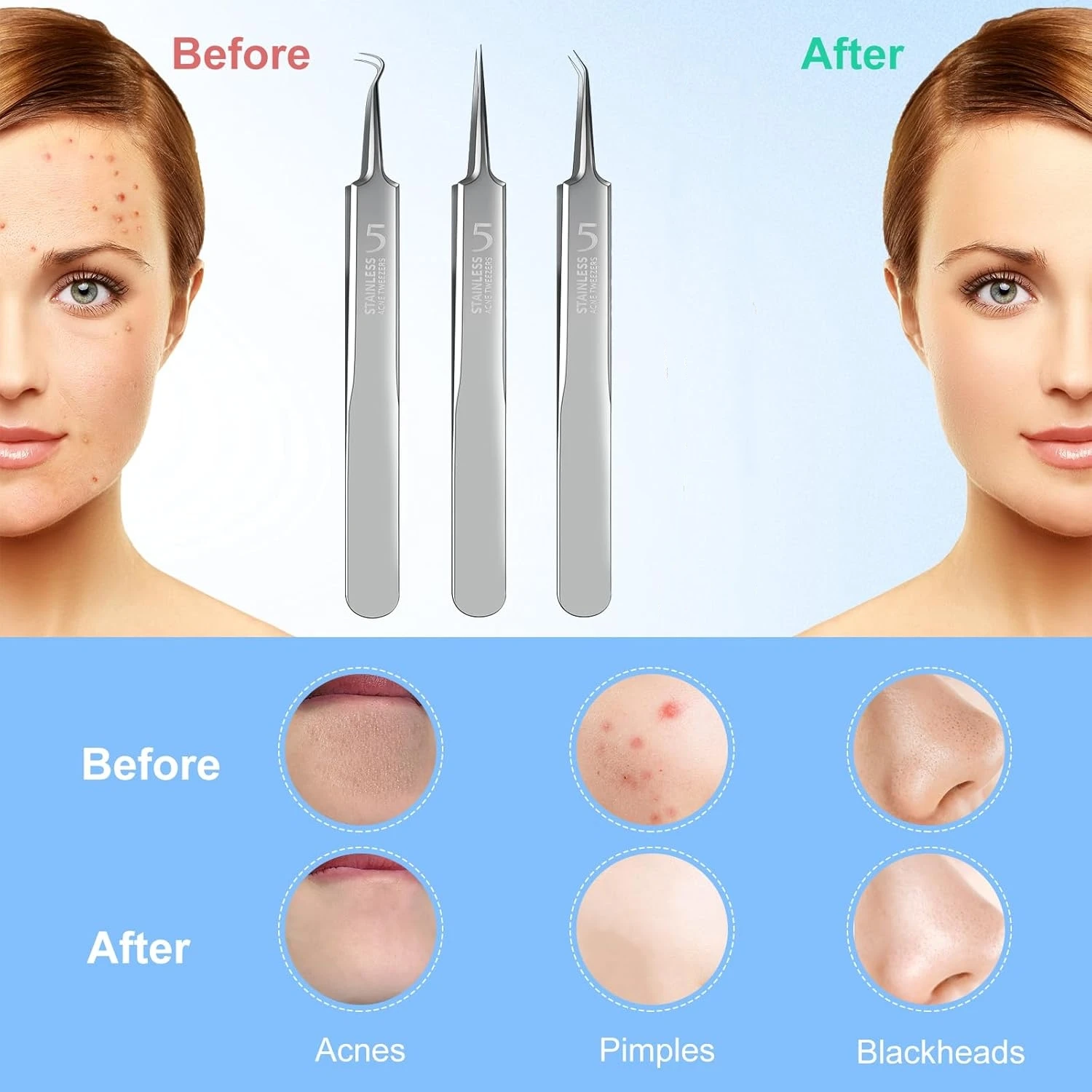 ชุดเครื่องมือกำจัดสิวหัวดำสแตนเลส 3 ชิ้น, คลิปหนีบสิวหัวดำ, แหนบ, เครื่องกำจัดสิวหัวดำบนใบหน้าเพื่อความงาม, เครื่องมือเข็มรักษาสิว
