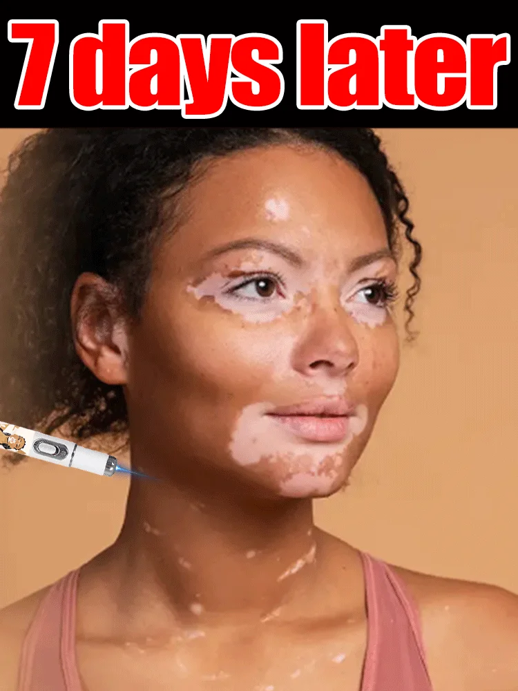 

2nd ᵍᵉⁿᵉʳᵃᵗⁱᵒⁿ ᵘᵖᵍʳᵃᵈᵉᵈ Vitiligo ⸴ ʳᵉpᵃⁱʳ Vitiligo ⸴ ᑫᵘⁱᶜᵏˡʸ